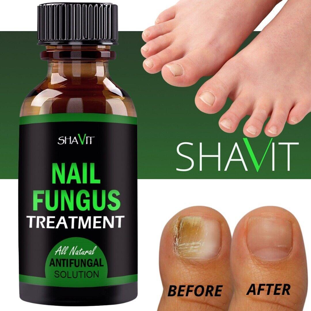 ANTI FUNGAL TREATMENT EXTRA STRENGTH TOENAIL FUNGUS ATHLETES FOOT FUNGI NAIL - Miami beauty1