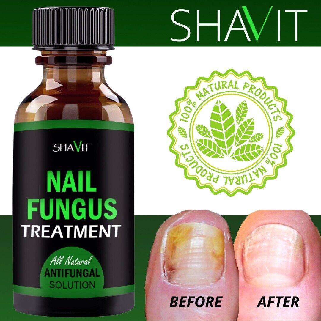 ANTI FUNGAL TREATMENT EXTRA STRENGTH TOENAIL FUNGUS ATHLETES FOOT FUNGI NAIL - Miami beauty1