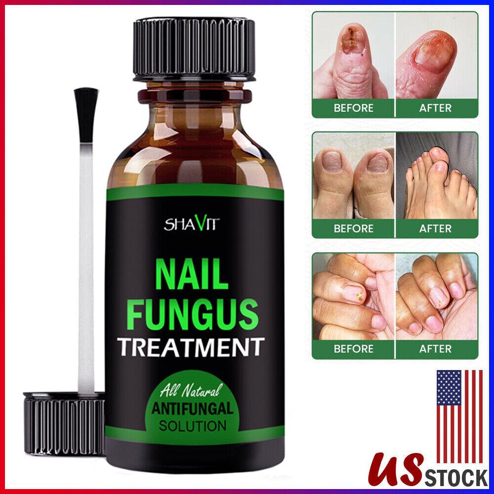 ANTI FUNGAL TREATMENT EXTRA STRENGTH TOENAIL FUNGUS ATHLETES FOOT FUNGI NAIL - Miami beauty1