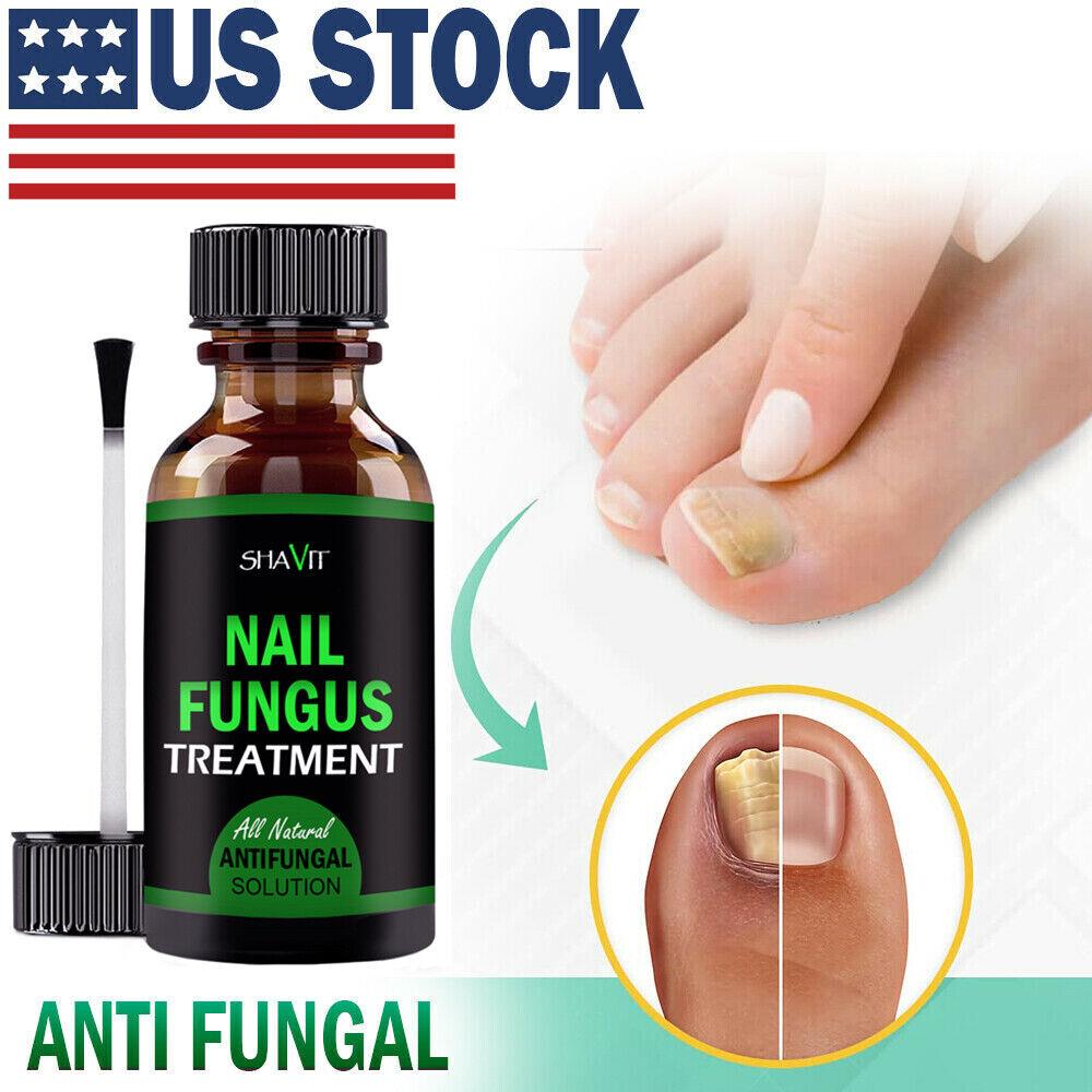 ANTI FUNGAL TREATMENT EXTRA STRENGTH TOENAIL FUNGUS ATHLETES FOOT FUNGI NAIL - Miami beauty1