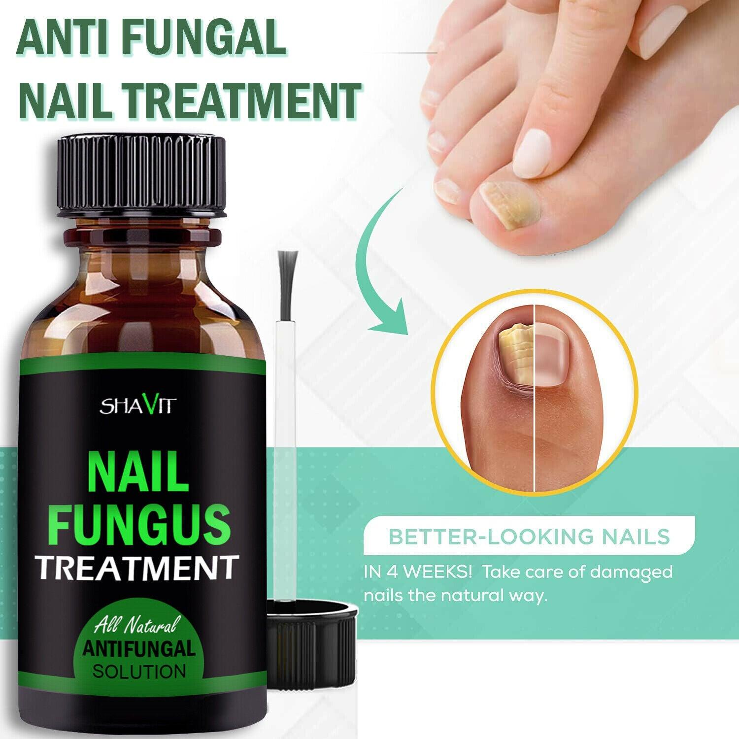 ANTI FUNGAL TREATMENT EXTRA STRENGTH TOENAIL FUNGUS ATHLETES FOOT FUNGI NAIL - Miami beauty1